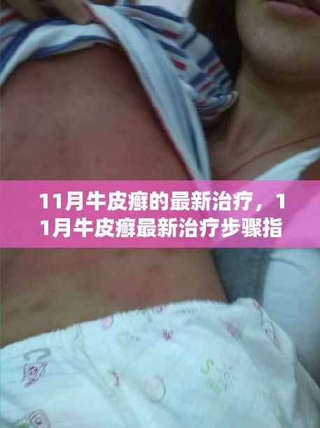 11月牛皮癣最新治疗指南,初学者与进阶用户适用的步骤和策略