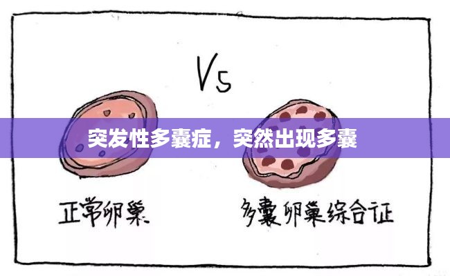 突发性多囊症,突然出现多囊